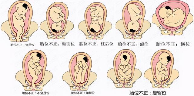 宝宝胎位不正你会看吗？
